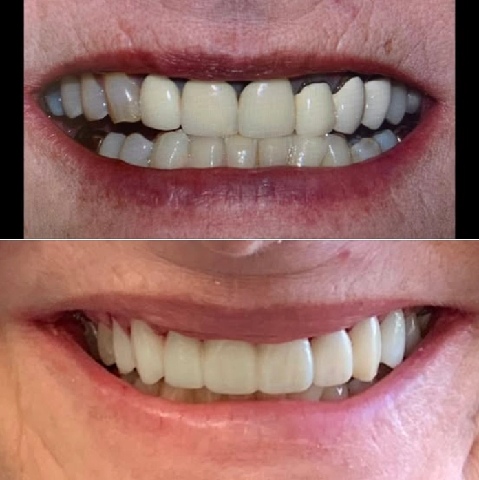 This kind woman just had her front 8 teeth prepared for new life-like ceramic restorations