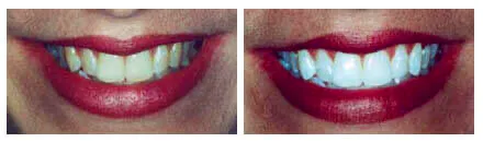 Teeth Whitening in Boise