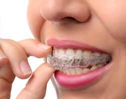Invisalign